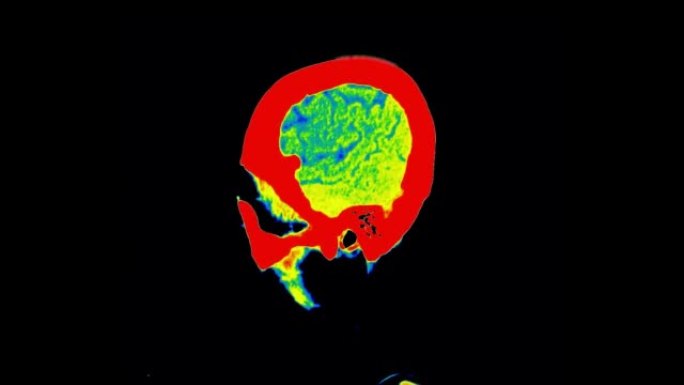 滤色模式下的大脑ct扫描
