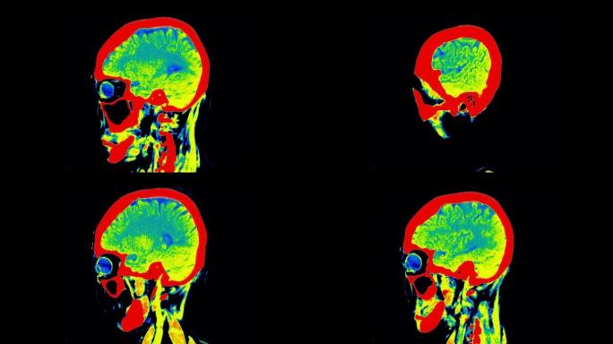 滤色模式下的大脑ct扫描