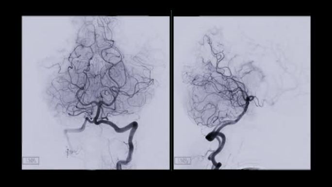 脑血管造影