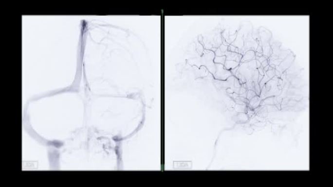 脑血管造影