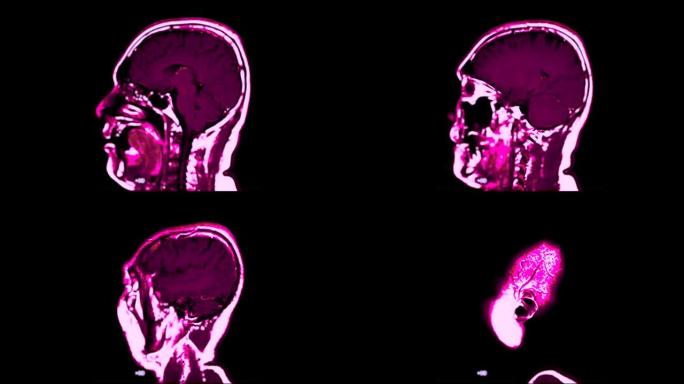 脑矢状面的MRI。