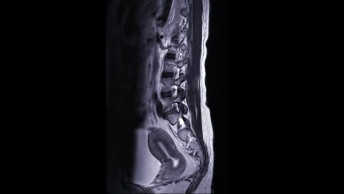 MRI l-s脊柱或腰椎矢状面T2W技术诊断脊髓压迫。