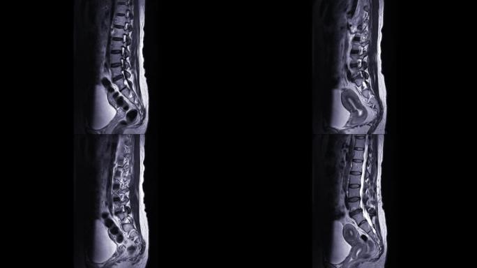MRI l-s脊柱或腰椎矢状面T2W技术诊断脊髓压迫。