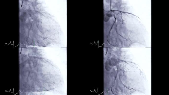 冠状动脉血管造影。