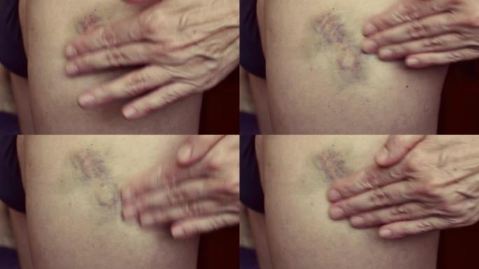 女人的手在腿上的一块大瘀伤上涂抹乳膏。特写。