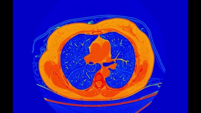 彩色模式下肺部ct扫描或胸部ct扫描。