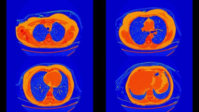 彩色模式下肺部ct扫描或胸部ct扫描。