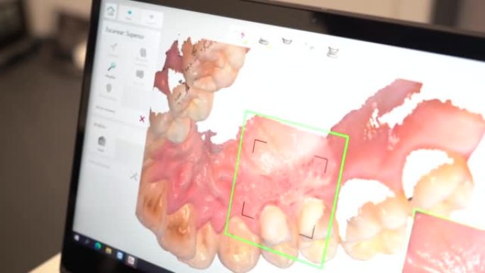 牙科诊所，牙医用电脑对病人进行3d扫描
