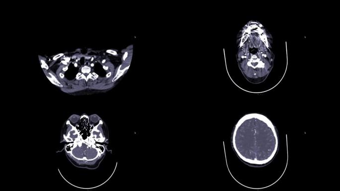 CTA脑和颈部或CTA脑动脉和颈动脉。
