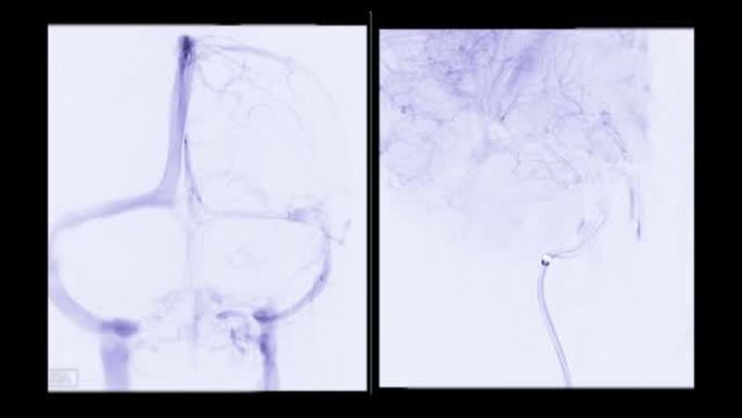 脑血管造影