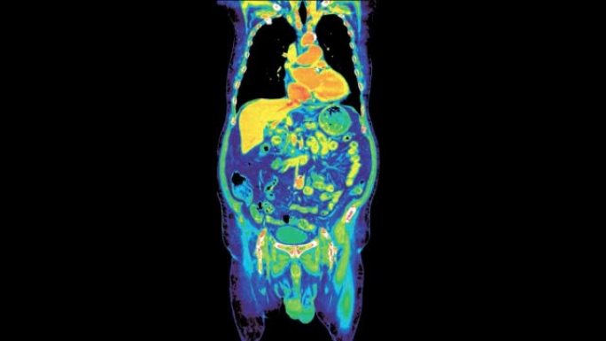 彩色模式胸腹部ct扫描或Pet扫描。