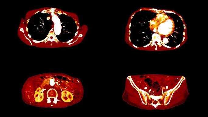 彩色模式胸腹部ct扫描或Pet扫描。