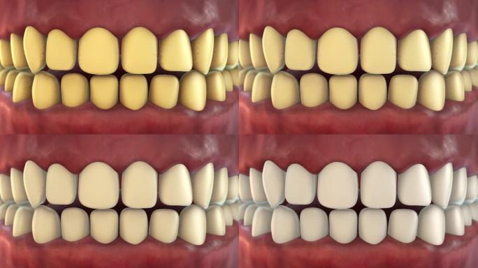 黄色牙齿到白色牙齿或牙齿美白动画