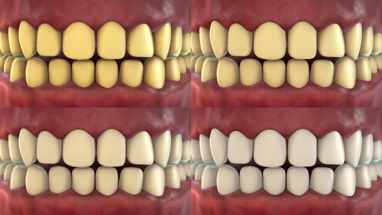 黄色牙齿到白色牙齿或牙齿美白动画