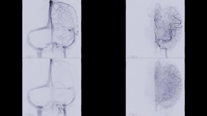 脑血管造影