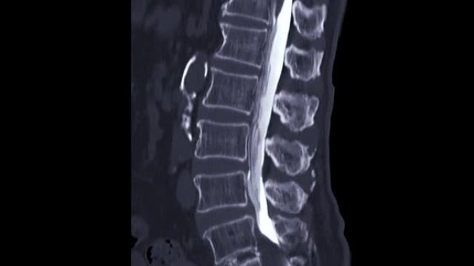 CT脊髓造影