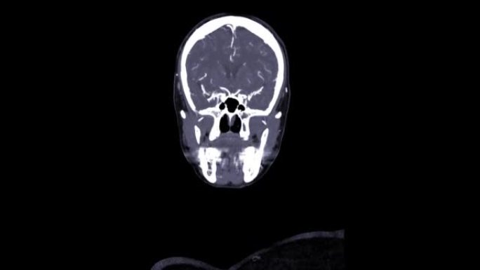 CTA脑和颈部或CTA脑动脉和颈动脉。