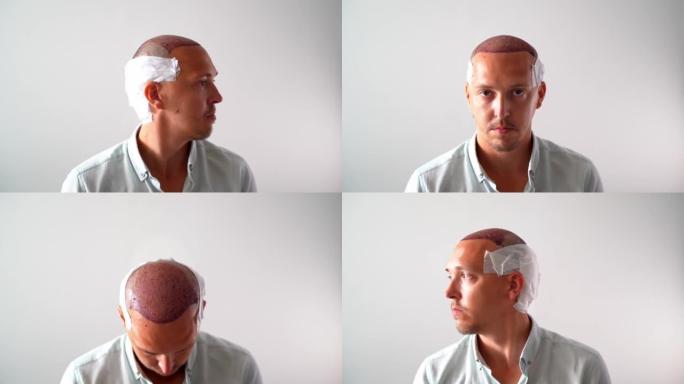 毛发移植后移动毛囊的手术技术。穿着绷带的年轻秃头男子脱发问题。带有复制空间的白色背景。