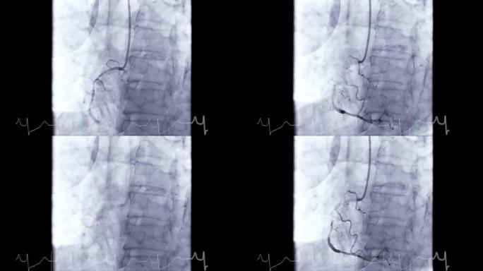 冠状动脉血管造影。