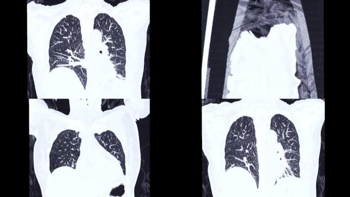 CT胸部或ct扫描
