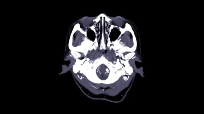 CTA脑和颈部或CTA脑动脉和颈动脉。