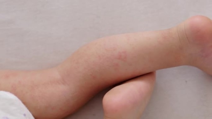 异位性湿疹皮炎对睡觉的婴儿腿，红色刺激过敏性疾病