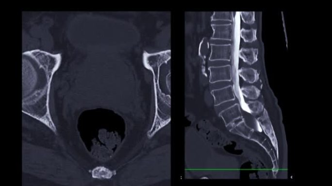 CT脊髓造影