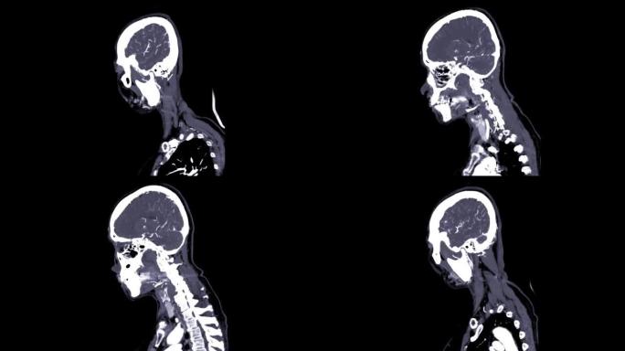 CTA脑和颈部或CTA脑动脉和颈动脉。