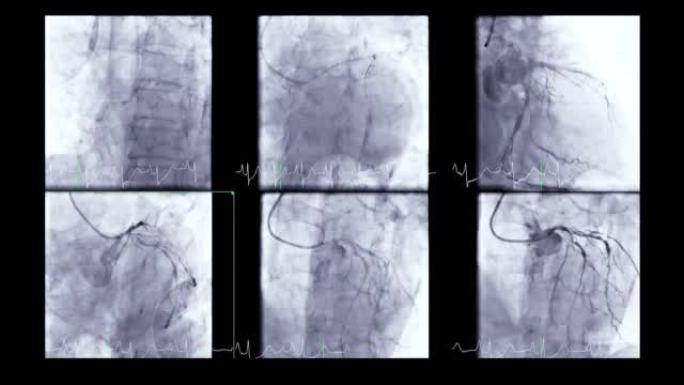 冠状动脉血管造影。