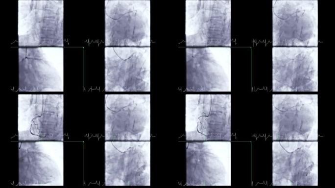 冠状动脉血管造影。