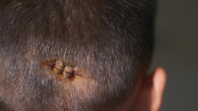 医院急诊室用尼龙缝合线缝合的儿童后头撕裂缝合伤口约3针