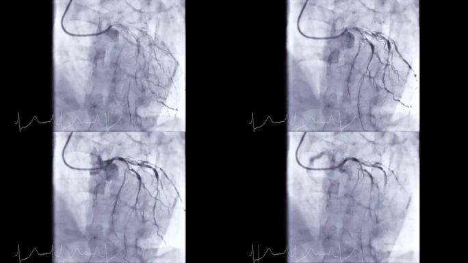冠状动脉血管造影。