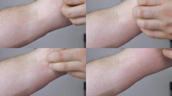 一个男人的手，他用他的手挠他的手由于皮炎和瘙痒的感觉。