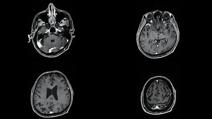 用钆造影剂对大脑进行MRI。