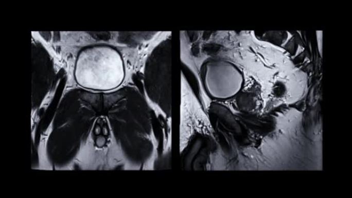 MRI前列腺