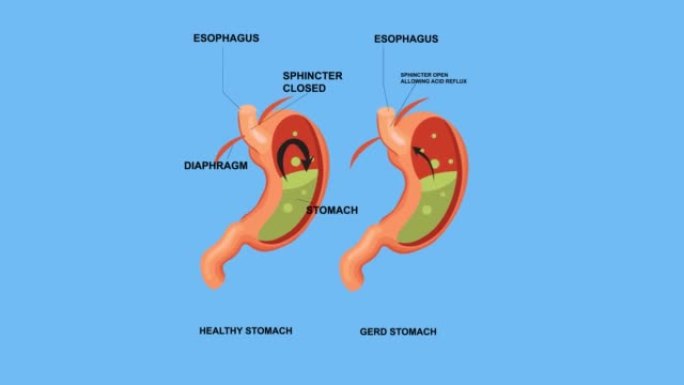 健康胃和胃gerd的比较