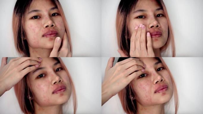 亚洲妇女因皮肤过敏感染疾病而抓伤脸。她脸上有红色皮疹。