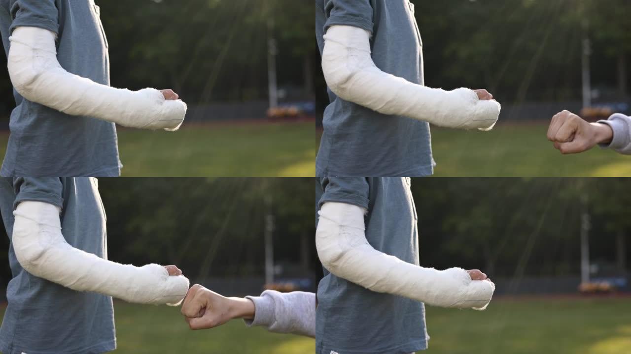 在夏日用拳头迎接另一个男孩的男孩断手的短拍。肢体骨折显示。手臂上的石膏。友谊。毁了暑假。