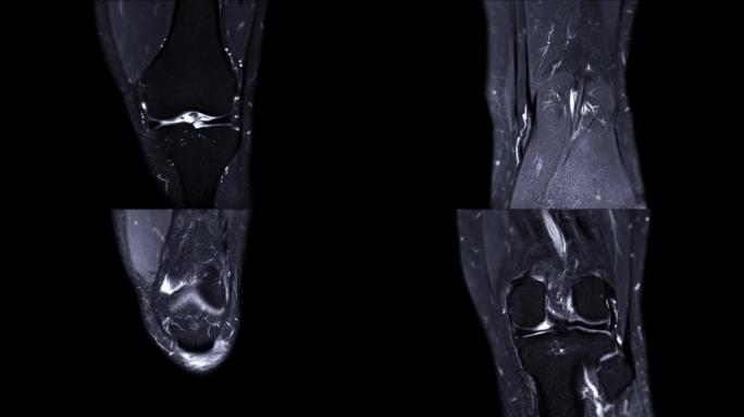 MRI膝关节。