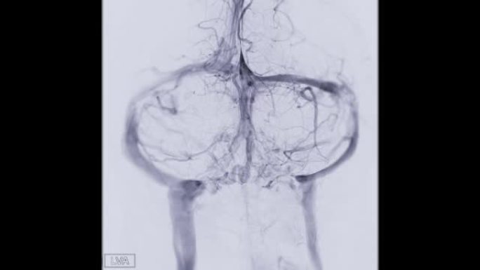 脑血管造影