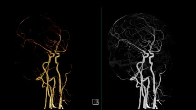 脑动脉ct血管造影术。