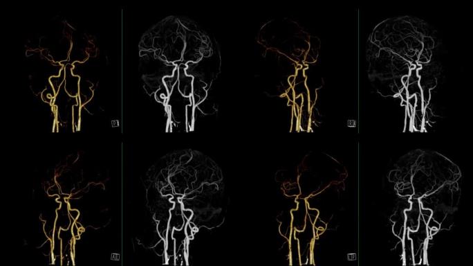 脑动脉ct血管造影术。