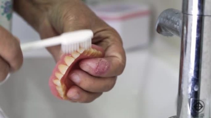 亚洲老年或老年女性患者使用牙刷清洁置换牙齿的局部义齿。