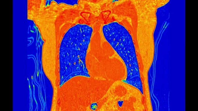彩色模式下肺部ct扫描或胸部ct扫描。