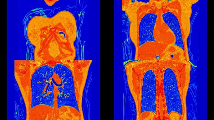 彩色模式下肺部ct扫描或胸部ct扫描。