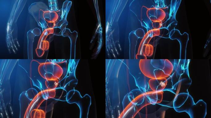 前列腺癌阴茎智慧医疗全息人体扫描