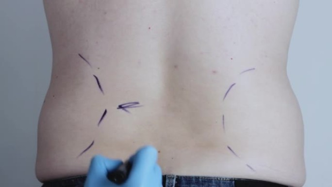 整形外科医生在男人的侧面用记号笔做标记，以抽出脂肪。腰部吸脂整形，特写