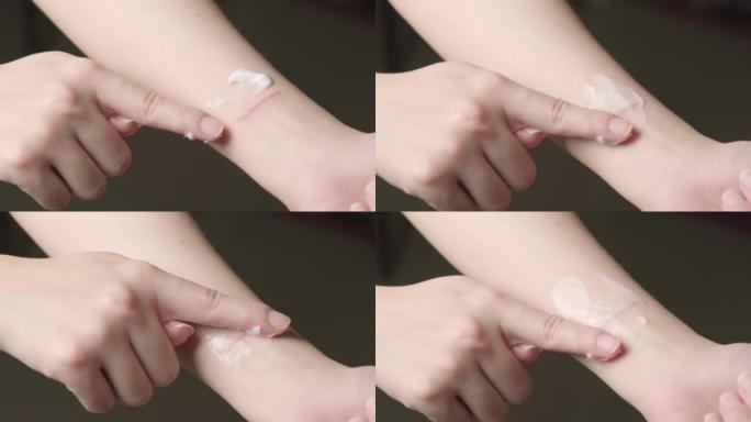 特写水泡，一名妇女使用除疤霜来治愈因热食用油溢出而导致的手上的第一性热烧伤。手指使用面霜治疗皮肤烧伤