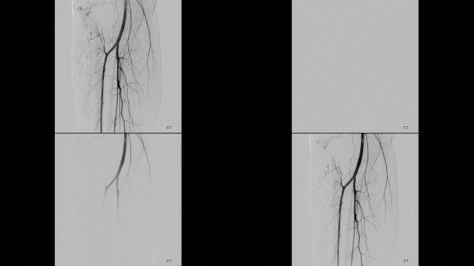 股骨血管造影。