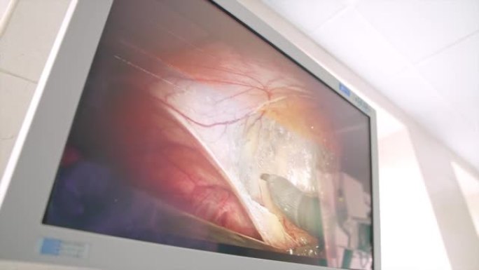 操作病人的高精度机械臂的复杂工作。手术室里显示手术的大屏幕。特写。